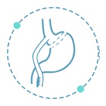 Roux-En-Y Gastrik Bypass Ameliyatı