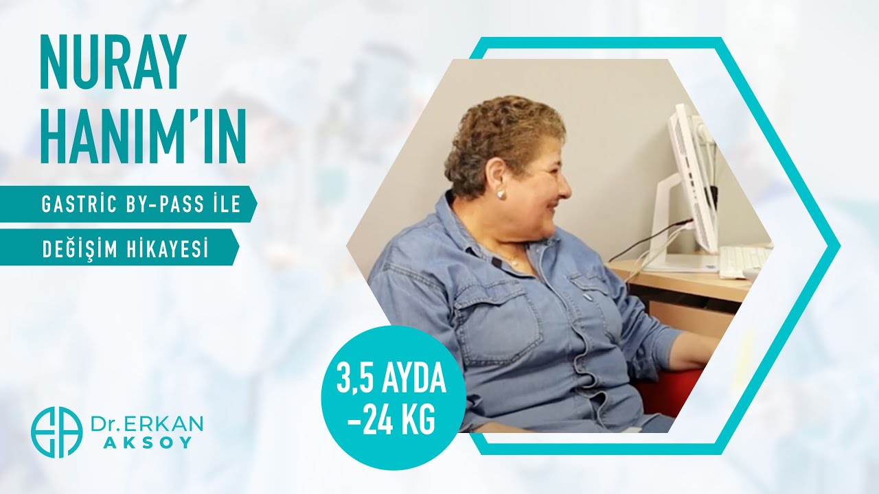 Nuray Hanim | Mi̇ni̇ Gastri̇k Bypass | 3,5 Ayda -24 Ki̇lo Verdi̇!